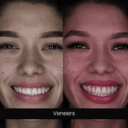 Smile Design and dental veneers enhance tooth shape, color and harmony to achieve a natural, aesthetic smile.